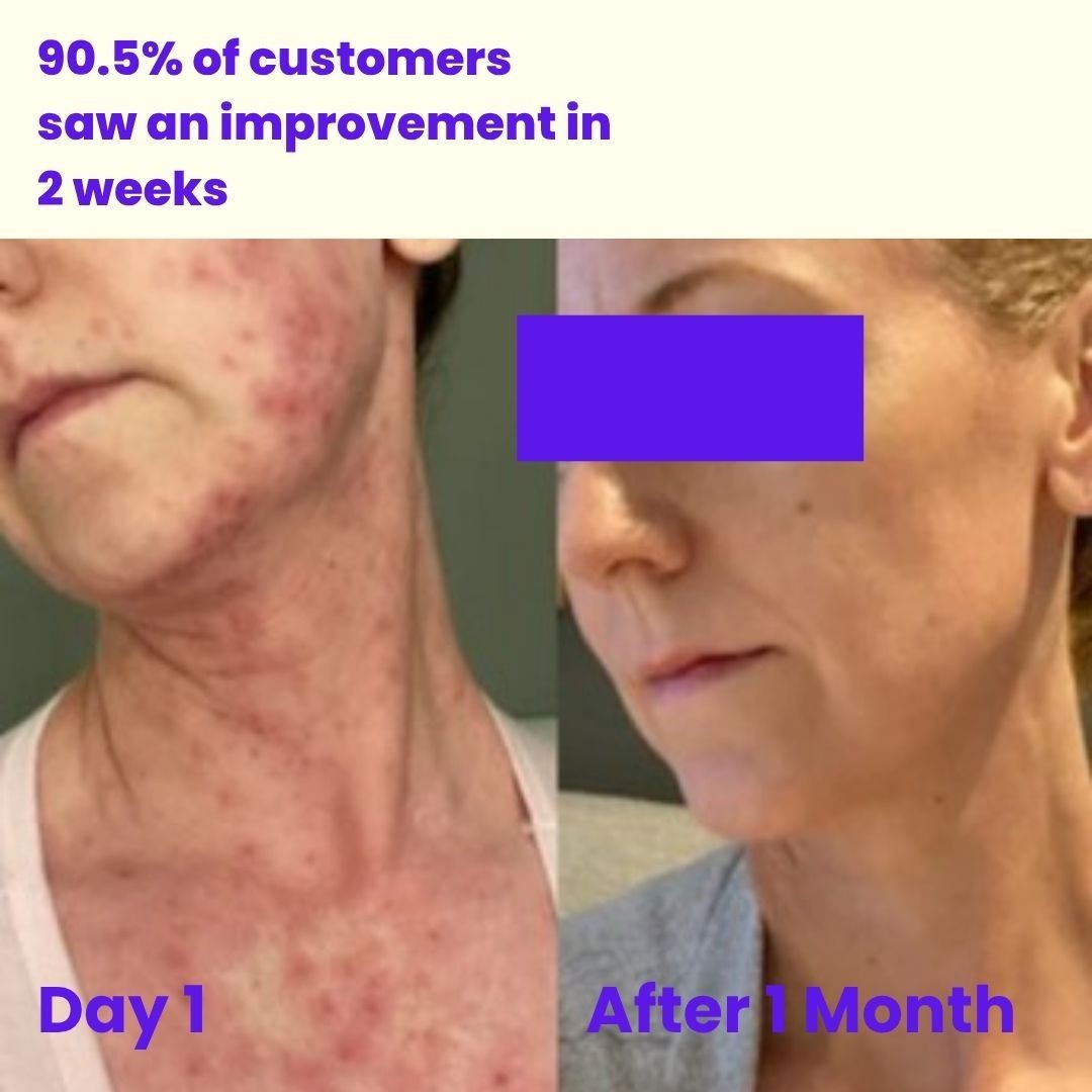 For Barrier Repair Grass-fed Tallow Cream For Eczema Acne Skin