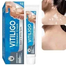 Vitiligo Treatment, Vitiligo Cream Improve Skin Pigmentation & Reduces White ...