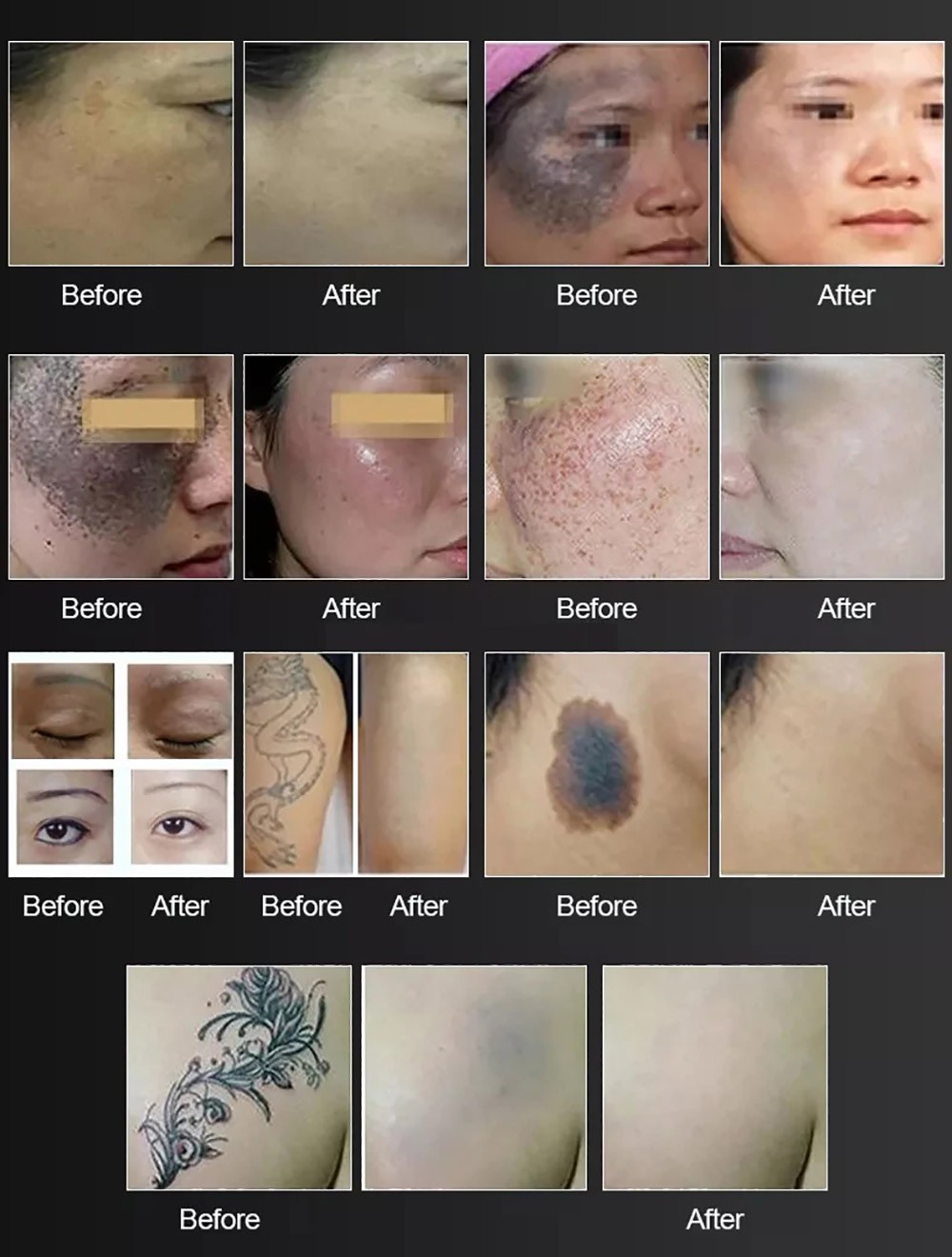 Pico Laser Beauty equipment ND YAG Laser Black Tattoo Removal peel machine