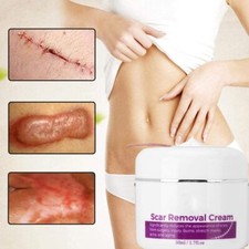 Scar Removal Cream, Stretch Mark Gel Ointment, Stretch Marks Removal Cream Scar