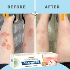 Health Care Psoriasis Cream Eczema Ointment Scalp Psoriasis Hand Tinea Foot 25g