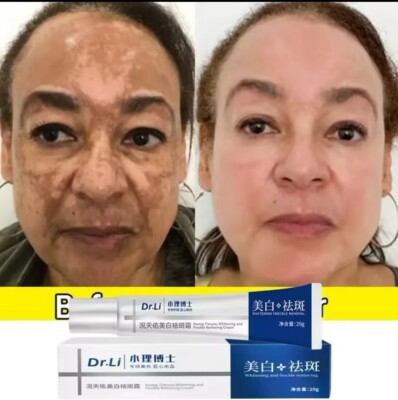 Effective Dark Spot Melasma Hyperpigmentation Freckles Spots Removal Face Cream