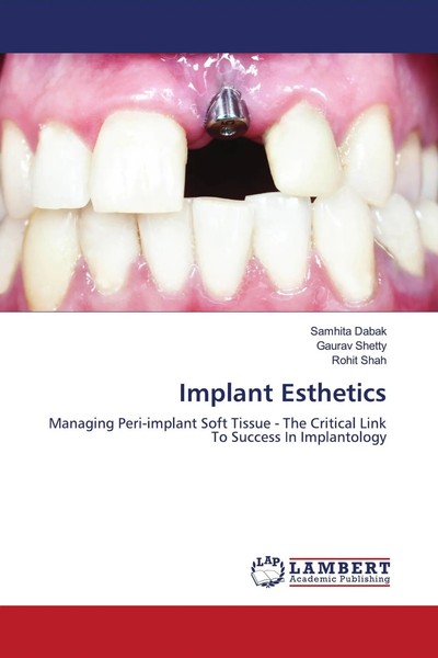 Implant Esthetics Samhita Dabak (U. A.) Taschenbuch Englisch 2021-image