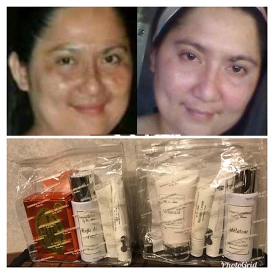 dr alvin melasma set