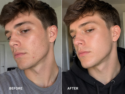 Dark Spot Corrector Cream for Face & Body Hyperpigmentation Acne Scar Treatment