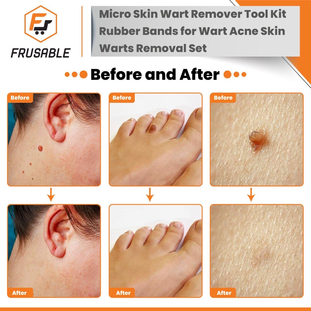 Micro Skin Tag Remover Tool Kit Rubber Bands for Wart Acne Skin Tags Removal US Osmani Trust