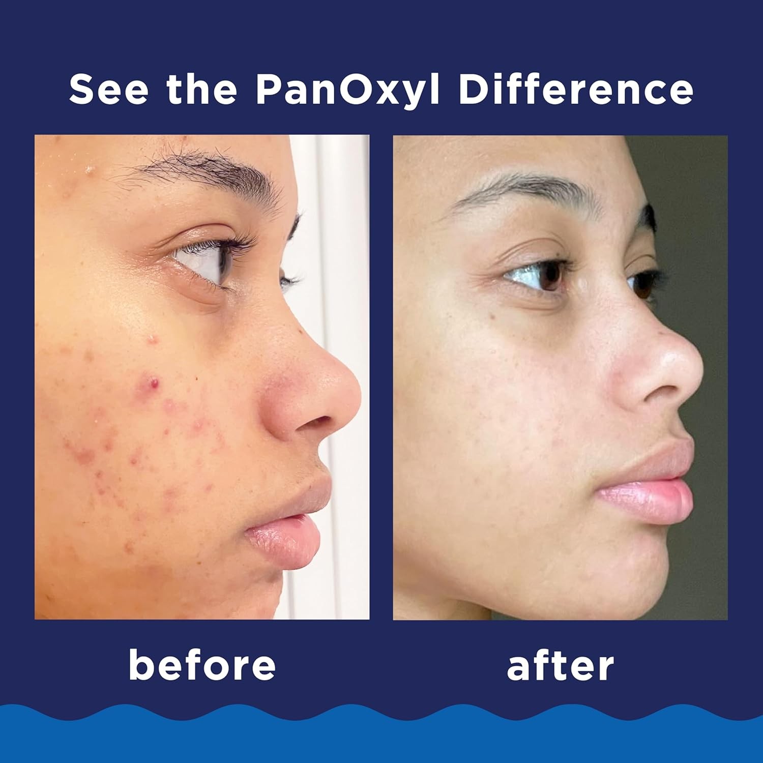 PanOxyl Acne Foaming Wash Benzoyl Peroxide 10% Maximum 5.5 Ounce (Pack of 1) 