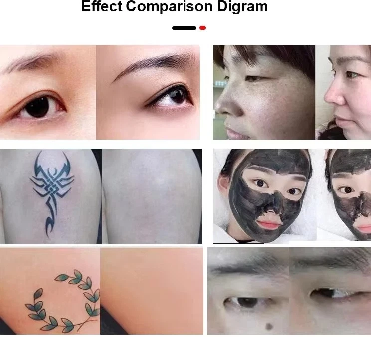 Pico ND YAG Laser Machine For Tattoo Removal Skin Whitening And Rejuvenation image 11
