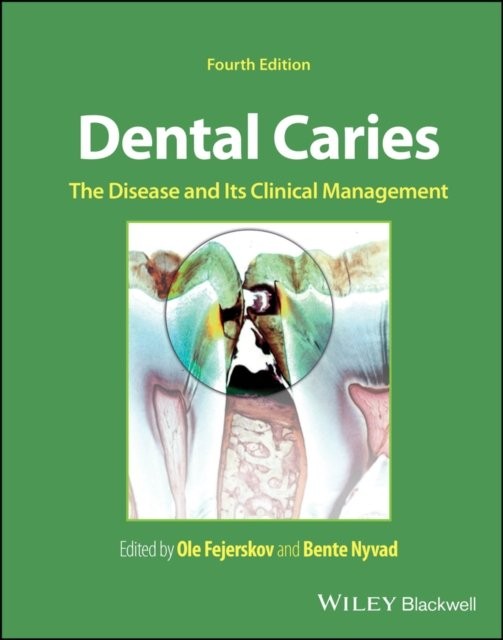 Dental Caries – The Disease and its Clinical Management 4th Edition
