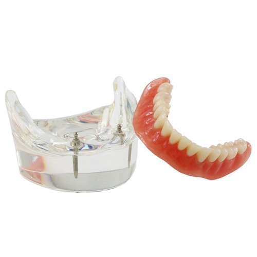 Demo modello denti Typodont restauro overdenture dentale con 2 impianti modello - Foto 3 di 12