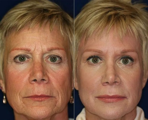 Crema antiarrugas con retinol + colágeno, ácido hialurónico, vitamina C - Imagen 7 de 10