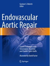 Endovascular Aortic Repair David Factor