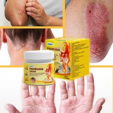Psoriasis Antifungal Rosacea Shingle Eczema Dermatitis Fast Relief Cream 20g