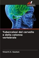 Vinod K. S. Gautam | Tubercolosi Del Cervello E Della Colonna Vertebrale | Buch