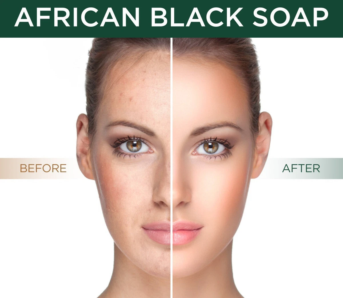 Black soap and acne deals