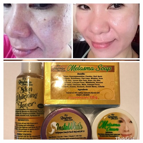 Melasma Set AntiAcne Dark Spot Severe Melasma 100 Sri Lanka Ubuy