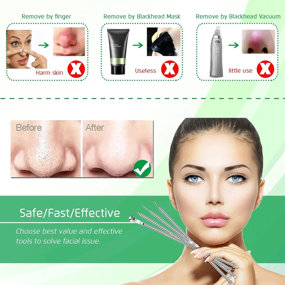 5PCS Blackhead Remover Comedone Extractor, Curved Blackhead Tweezers Kit, Profes - Image 2 of 4