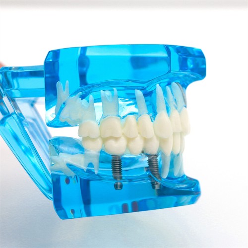 Multiple Types Dental Teeth Model Ortho Implant Practice Teaching Demo Model - Picture 194 of 276