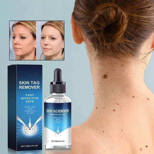 Wart Remover Serum Fast Safe Natural Treatment Skin C3J2 30ml Tags G7I7 Y8E2 - Picture 2 of 15