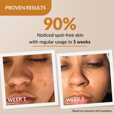 Fixderma 2% Kojisäure + 1% Arbutin Skarfix-Plus Narbenentfernungscreme | Hype...