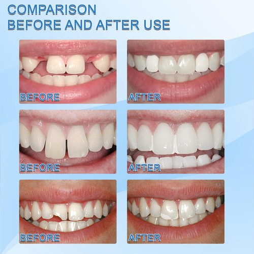 Kit de reparación dental temporal de 30 ml dientes y huecos dientes postizos pegamento sólido herramienta de dentadura - Imagen 7 de 19