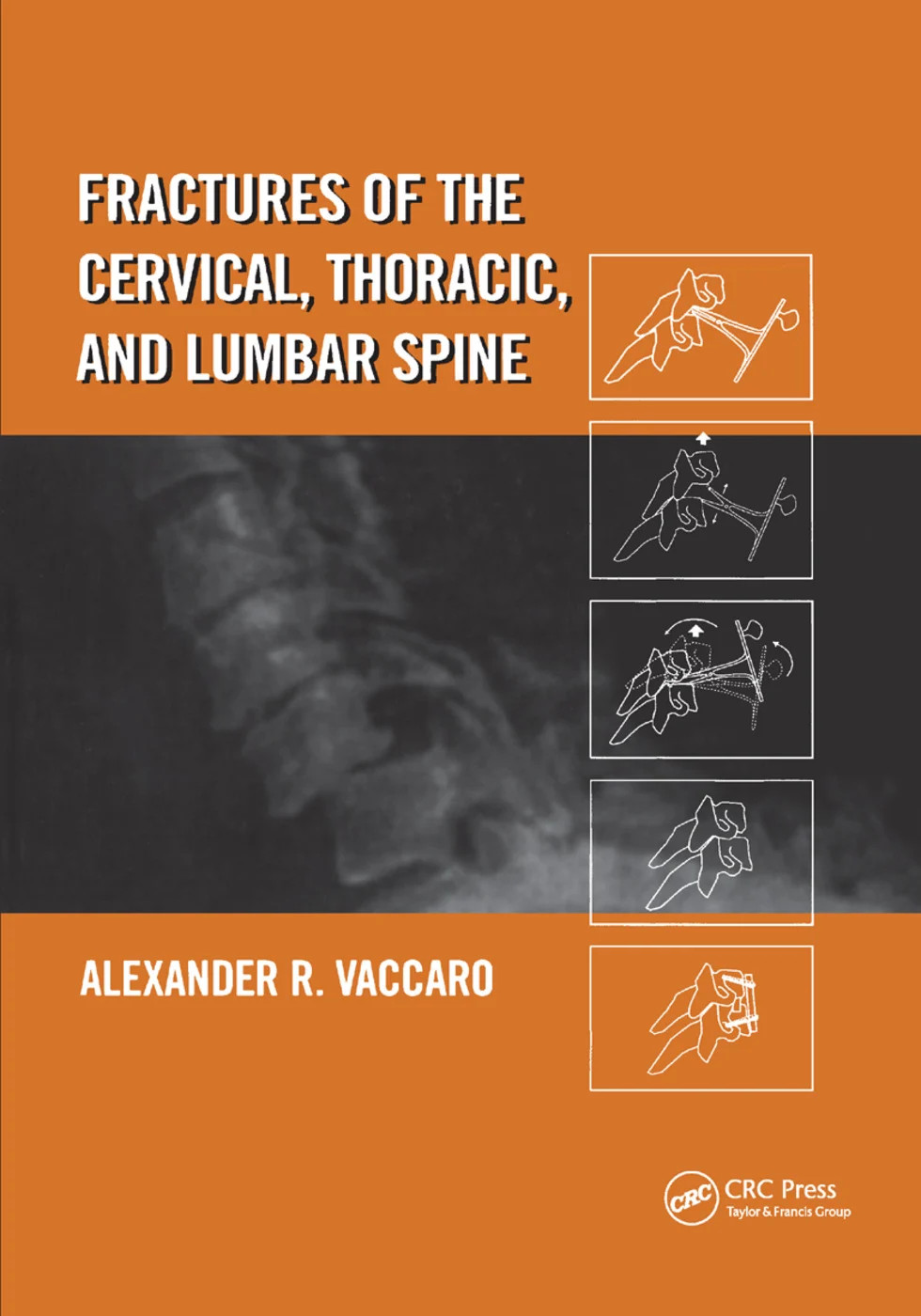 Fractures of the Cervical, Thoracic, and Lumbar Spine