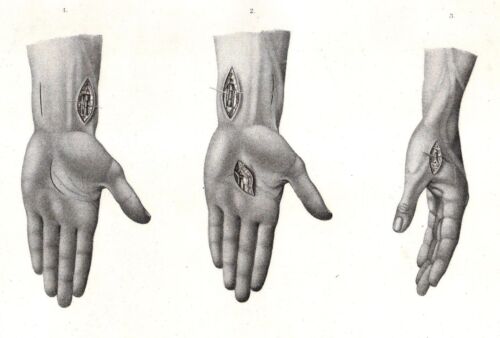 Operative Tafel IX. Unterbindung der Arterien über dem Handgelenke und in der Ha - Afbeelding 1 van 1
