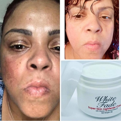 WHITE FADE SUPER SKIN LIGHTENER; PARA REMOVER MANCHAS OSCURAS DE LA PIEL, 2oz - Picture 13 of 13