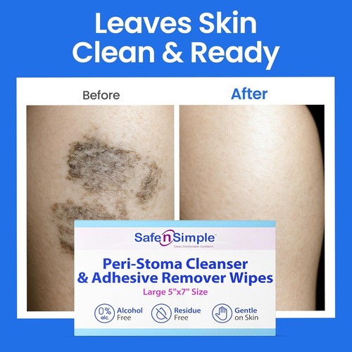 Adhesive Remover for Skin - 5"x7" 50 Wipes - Stoma Adhesive Remover Wipes - A... - Picture 8 of 8