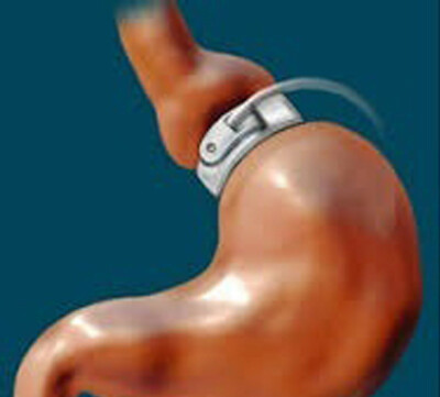 Gastric Band Hypnosis CD,Try BEFORE DANGEROUS PILLS, Subliminal Fat Burn 
