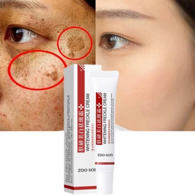 Whitening Sommersprossen Creme Entfernen Dunkle Flecken Anti Sommersprossen Creme Niacinamid Verblassen