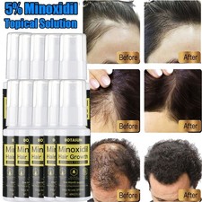 Minoxidil 5% Spray Men Hair Regrowth Treatment Solution 1-10 Month Supply 60ml