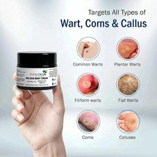 7 Days Genital Wart Removal Cream for Men Women 50 GM