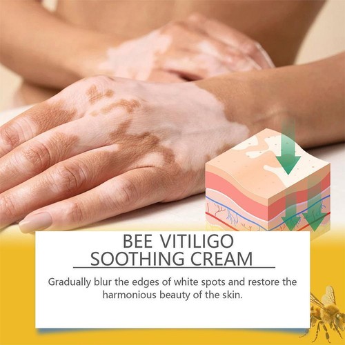 Bee Vitiligo Care Cream,Bee Vitiligo Care Cream For All Types Skin New - Picture 10 of 19