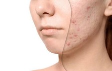Acne Cream