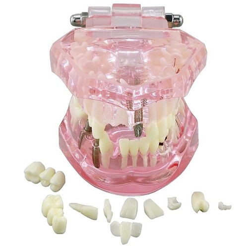 Couronnes Dentaires Provisoires Pour Molaires - Protection De La Pulpe Dentaire - Lot - Neuf