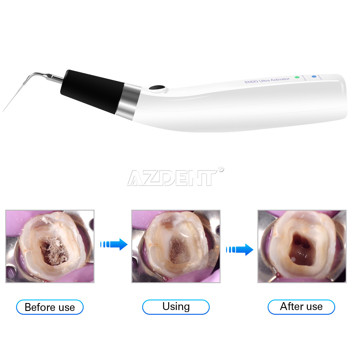 AZDENT Dental Endo Ultrasonic Sonic Activator Root Canal Irrigator+6 Tips USA