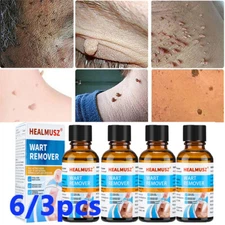 6/3x Wart Remover Liquid Skin Tag Mole Remover Eliminate Feet Corn Wart Remove