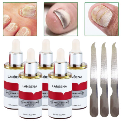 5/3 x Nail Repair Essence Remove Onychomycosis Serum Fungal Nail Treatment Oil
