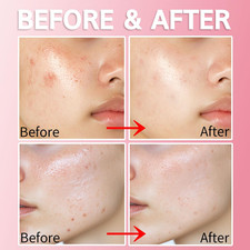 Blemish Spot Treatment Gel with Salicylic Acid 2 , Soothing Acne Care for Irr...