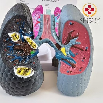 Human Pathological Heart-lung Anatomy Model Respiratory System of The Lungs