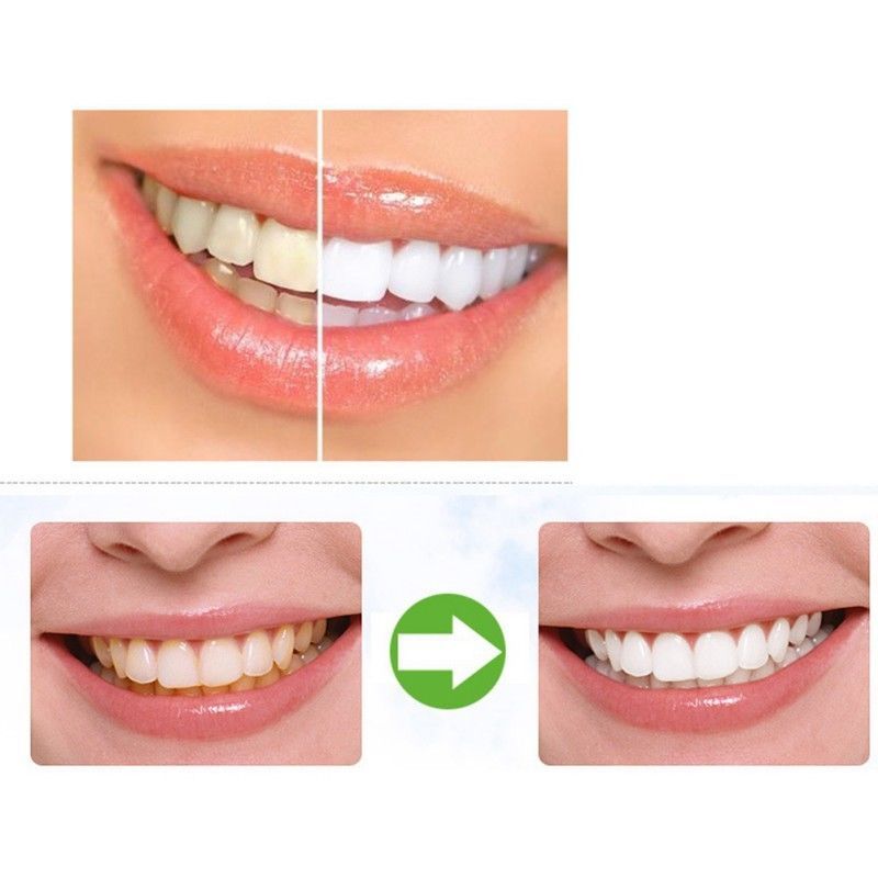 Advanced Teeth 14 Pouches/28 Bands Whitening Kit White Teeth