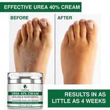 Urea Cream 40 Salicylic Acid Crack Skin Repair Cracked Feet Callus RemoverCream