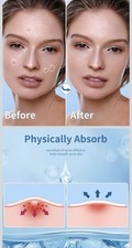 Pimple Patches For Face 300 Count Acne Patches Hydrocolloid Patches For Blemish