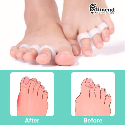 PEDIMEND  Silikon Gel Zehenabscheider für überlappende Zehenhammer Zehenglätter