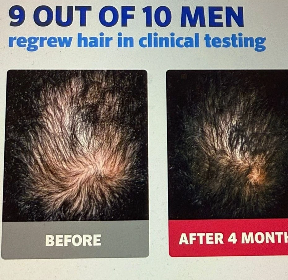 Kirkland Signature Minoxidil Foam 5% for Men – 6 Month Supply (6 x 2.11 oz) - Image 3 of 4