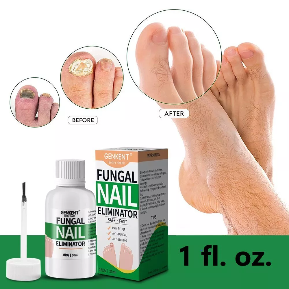 Extra Strength Toenail Fungus Treatment for Toenail or Fingernail, Nai –  HolioCare Global