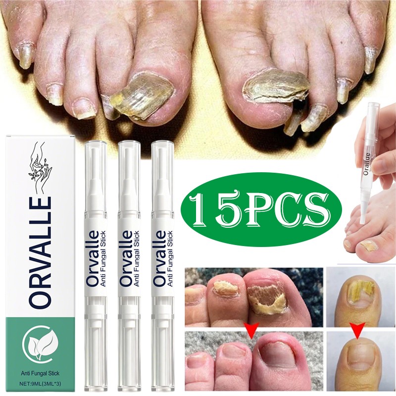 3-15 Orville Nail Fungus Pen Anti Fungus Infection Nail Care Repair Pen Toenail