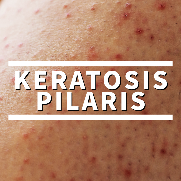 Pruderma KP lotion, keratosis Pilaris treatment 15 Lactic Acid bump