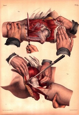 1854 French Surgical Print Hip Amputation Béclard & Lisfranc + Description Page